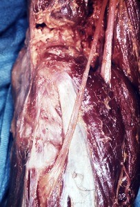 Natural color photograph of dissection of the left knee, lateral view, showing the common fibular nerve as it courses anteriorly, inferior to the fibular head