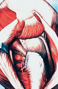 Illustration of right trochanteric bursa (synovial) following vertical division and retraction of the gluteus maximus muscle and separation of the gluteus medius muscle from the greater trochanter and reflection upward