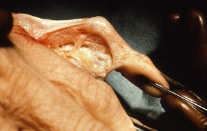 Natural color photograph of dissection of the left fifth digit, lateral view