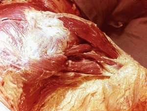 Natural color photograph of dissection of the right shoulder, inferoposterior view, with the skin removed to expose the posterior and inferior muscles of the shoulder