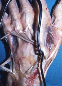 Natural color photograph of dissection of the dorsal surface of the left hand, with the extensor tendons retracted