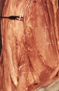 Natural color photograph of deep dissection of the left femoral triangle, with the iliopsoas and pectineus muscles