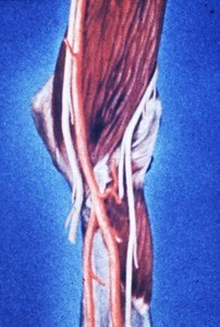 Illustration of right cubital fossa, showing the arteries and nerves that cross it (brachial artery at its bifurcation, median and radial nerves); the brachialis muscle and pronator teres muscle; note also the medial and lateral humeral epicondyles