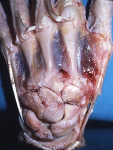 Natural color photograph of dissection of the dorsal surface of the left hand, showing the carpal bones