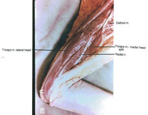 Natural color photograph of right arm, lateroposterior view, showing muscles and nerve