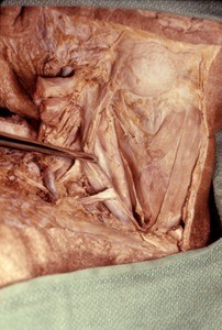 Natural color photograph of dissection of the right side of the neck, lateral view, with the carotid sheath opened and the right internal jugular vein retracted laterally from the right common carotid artery