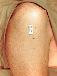 Natural color photograph of the right shoulder and upper arm, lateral view, showing surface anatomy