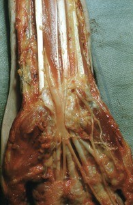 Natural color photograph of dissection of the right hand and wrist, anterior view, showing the distal branches of the median nerve