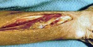 Natural color photograph of superficial dissection of the forearm