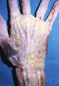 Natural color photograph of dissection of the right hand, anterior view, superficial