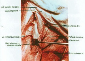 Natural color photograph of dissection of the superior portion of the right thigh, anterior view; the rectus femoris muscle has been retracted to expose the lateral femoral cutaneous artery