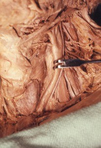 Natural color photograph of dissection of the left side of the neck, anterolateral view, showing the left common carotid artery bifurcating to become the right external and internal carotid arteries