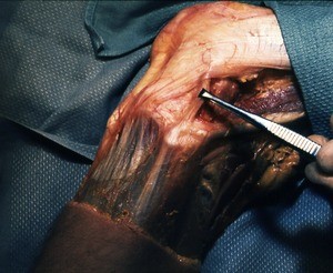 Natural color photograph of dissection of the left knee, lateral view, with the forceps around the fibular collateral ligament