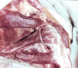 Natural color photograph of dissection of the right shoulder, posterior view