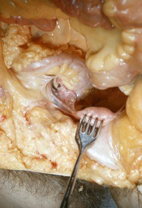 Natural color photograph of dissection of the pelvic cavity, superior view, showing the boundaries of the rectouterine pouch and structures associated with the uterus