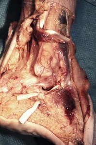Natural color photograph of dissection of the right ankle, lateral view, with the fibularis longus t. and the fibularis brevis t. cut and reflected