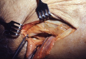 Natural color photograph of dissection of the left inguinal region, anterior view