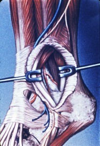 Illustration of left ankle, lateral aspect, fibularis longus & brevis muscles retracted to demonstrate the fibular (peroneal) artery and its lateral tarsal branch