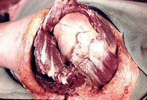 Natural color photograph of dissection of the right shoulder, superior view, with the deltoid muscle reflected to expose the glenohumeral joint