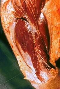 Natural color photograph of dissection of the arm and shoulder, anterolateral view