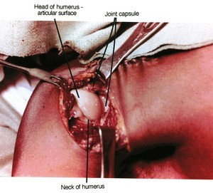 Natural color photograph of dissection of the right glenohumeral joint, anterior view, with the joint capusle opened to expose the head of the humerus