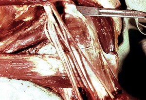 Natural color photograph of dissection of the left shoulder, anterior view, showing the brachial plexus