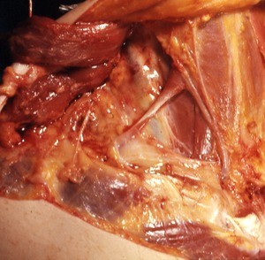 Natural color photograph of dissection of the neck, right anterolateral view, with the sternocleidomastoid muscle cut and reflected