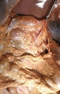 Natural color photograph of dissection of the abdomen, anterior view, with the transverse colon retracted to show the colic arteries