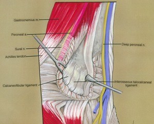 Illustration of dissection of the interosseous talocalcaneal ligament and Calcaneofibular Ligament, with the overlying musculature cut and reflected