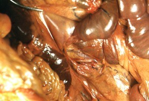 Natural color photograph of dissection of the peritoneal cavity, anterior view, showing abdominal viscera and associated mesentery