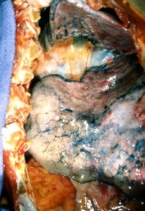 Natural color photograph of dissection of the thoracic cavity, anterior view