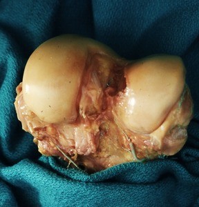 Natural color photograph of dissection of the medial and lateral condyles of the femur, superior view