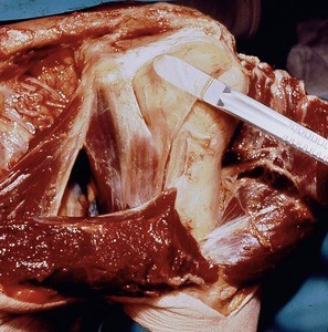 Natural color photograph of dissection of the left shoulder, anterior view, showing the relationships between the bones, muscles, and nerves of the shoulder