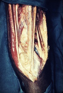 Natural color photograph of dissection of the right popliteal fossa, posteromedial view, showing muscles, tendons and vessels