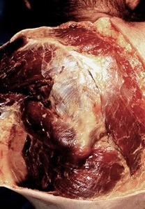 Natural color photograph of dissection of the left shoulder, posterior view, with the skin removed to expose the superficial muscles of the back