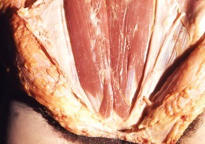 Natural color photograph of dissection of the anterior abdominal wall showing the rectus abdominis m. and pyramidalis m