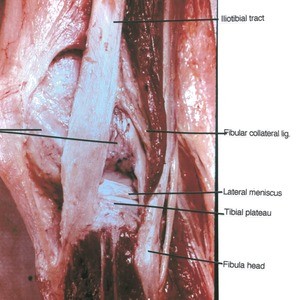 Natural color photograph of left knee, lateral view, showing bones, mensci and ligament