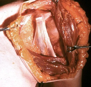 Natural color photograph of dissection of the left shoulder, anterior view, with skin and muscle layers retracted to expose the ligamentous attachments to the coracoid process