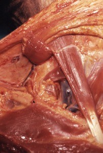 Natural color photograph of dissection of the right side of the neck, anterior view, with the clavicular head of the sternocleidomastoid muscle cut and reflected to expose the internal jugular vein