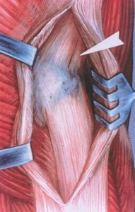 Illustration of right hip, lateral view, showing iliofemoral ligament with tensor fasciae latae and gluteus maximus retracted