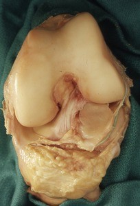 Natural color photograph of the left knee, showing the articular surface and the associated ligaments