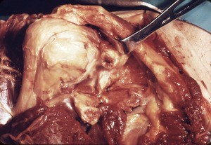 Natural color photograph of dissection of the right shoulder, anterior view, with the muscle layers removed to reveal the bone structure of the shoulder