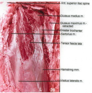 Natural color photograph of left hip, lateral view, showing muscles and bones with gluteus maximus muscle retracted