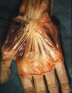 Natural color photograph of dissection of the right hand and wrist, anterior view, with the foreceps holding the flexor pollicis brevis muscle