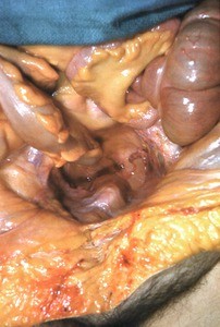 Natural color photograph of dissection of the pelvic cavity, superior view, showing the abdominal viscera and associated mesentery