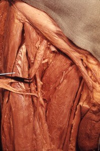 Natural color photograph of dissection of the right femoral triangle, showing the femoral vessels