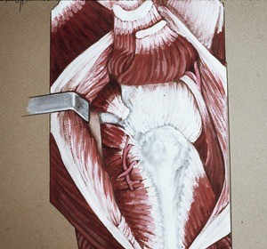 Illustration of exposure of right hip joint by cutting and reflecting glutei medius and minimus mm. and piriformis m. from their insertions; gluteus maximus is divided and retracted anteriorly and posteriorly