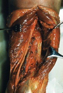 Natural color photograph of dissection of the popliteal fossa, showing the tibial nerve and the popliteal vessels