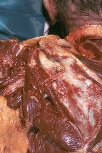 Natural color photograph of dissection of the left shoulder and back, posterior view, with the infraspinatus muscle removed to expose the scapula