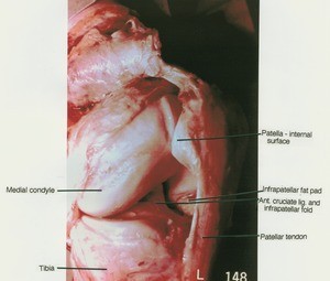 Natural color photograph of left knee, anteromedial view, showing bones, tendon, ligament and infrapatellar fat pad